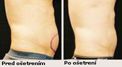 Výsledky chudnutia pomocou liposukcie ultrazvukom - kavitácia