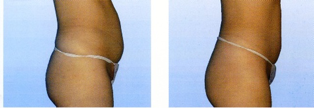 Terapia brucha Terapia brucha