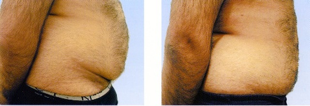 Terapia mužského brucha Terapia mužského brucha