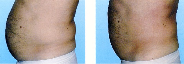 Terapia mužského brucha Terapia mužského brucha